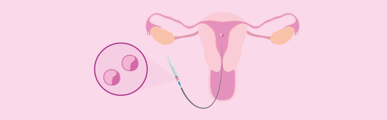 La transferencia embrionaria es más sencilla de lo pensabas