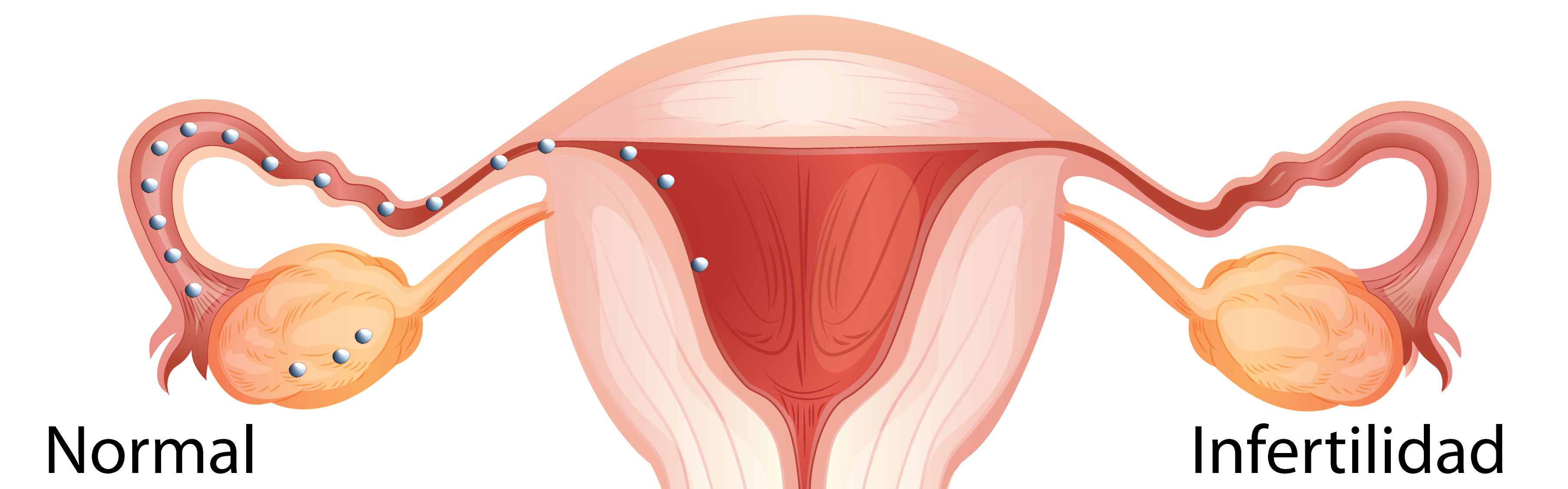 ¿Qué es el factor tubárico y cómo afecta la fertilidad?