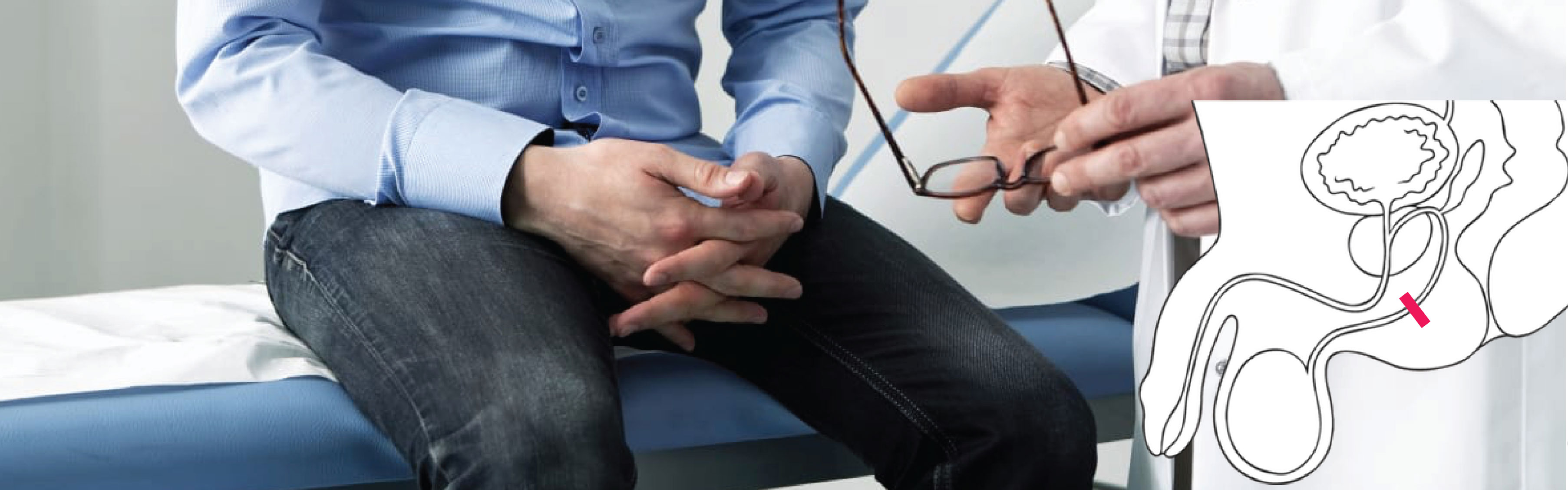 ¿Es reversible la vasectomía?