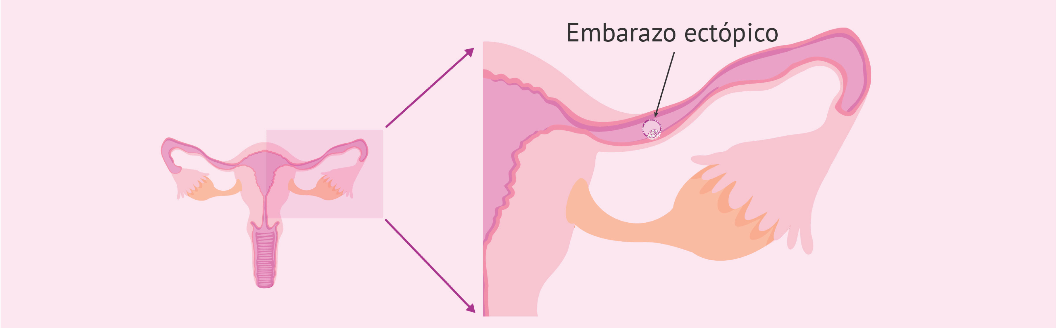 ¿Qué es y cuáles son los síntomas de un embarazo ectópico?