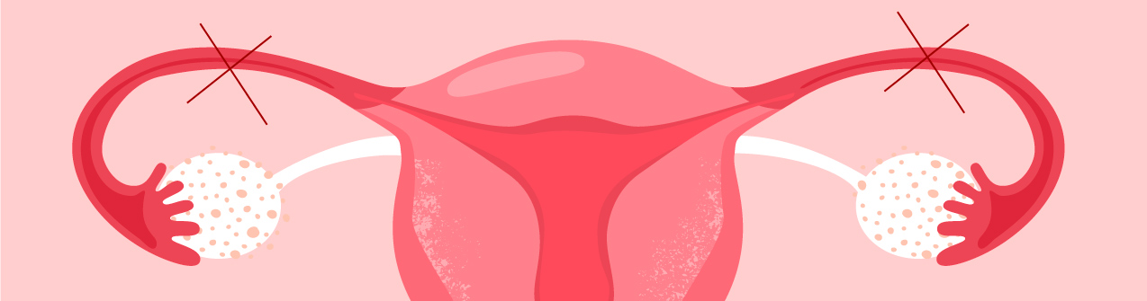 Me hicieron la salpingoclasia y ahora quiero embarazarme ¿Es posible?